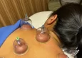 Hijama in Dubai