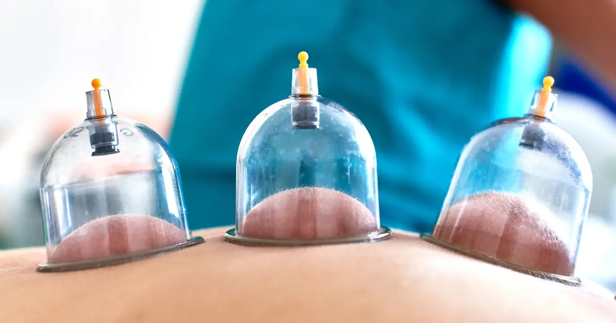 hijama in dubai