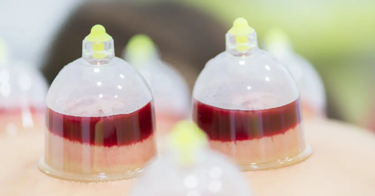 hijama in dubai